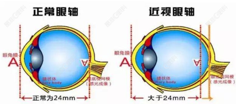 儿童用哺光仪治疗近视有效