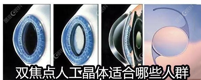 双焦点人工晶体适合哪些人群