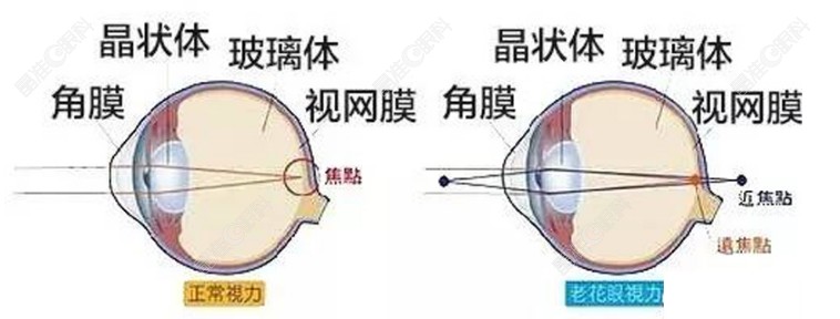 双焦点人工晶体适合白内障、高度近视、老花人群www.ji-zhun.com