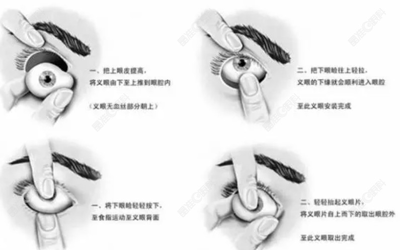 义眼片每天佩戴和摘取的方法