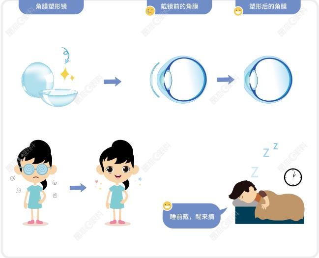 张沙沙医生角膜塑形镜优势