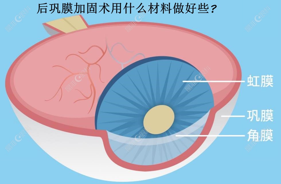 后巩膜加固术用什么材料做好些