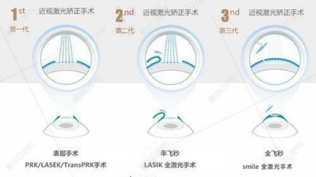 肇庆爱尔眼科医院做近视手术的原理