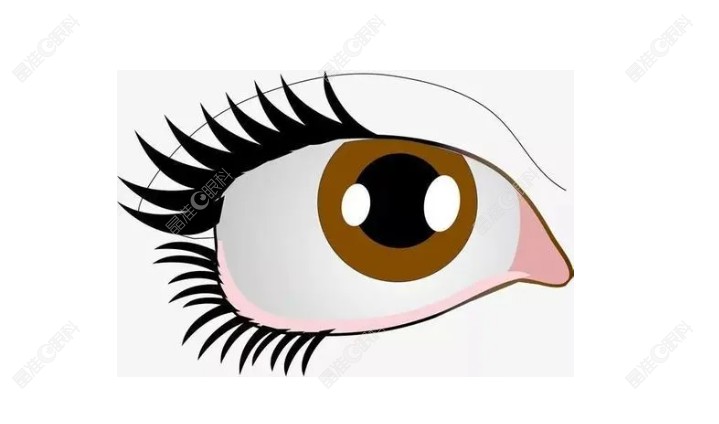 甲亢突眼手术治疗方案