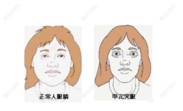 甲亢突眼与正常眼睛的对比