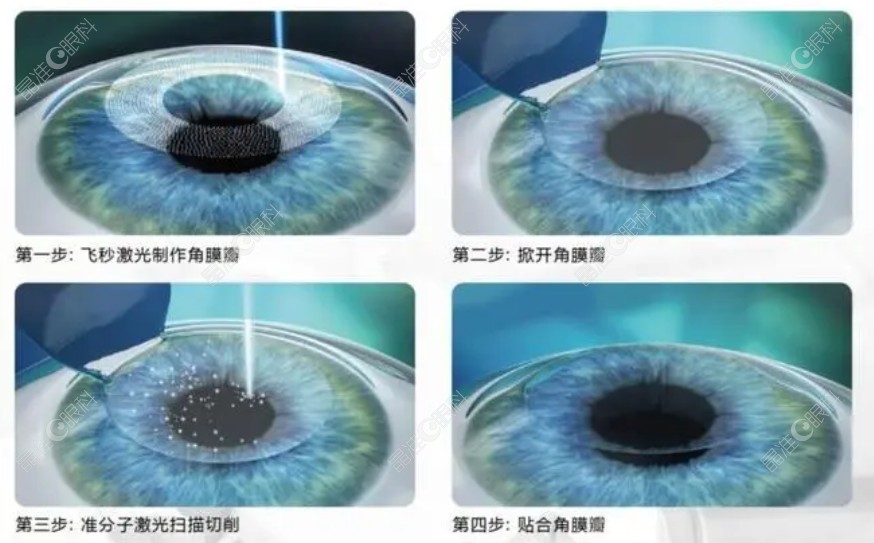 半飞秒激光手术过程