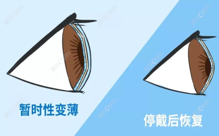 一般建议ok镜停戴1-3个月可做近视手术