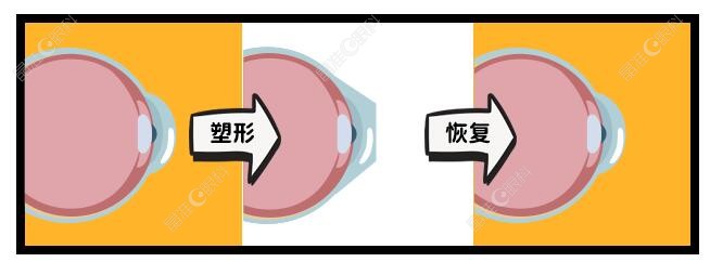 戴ok镜还能做激光近视手术吗