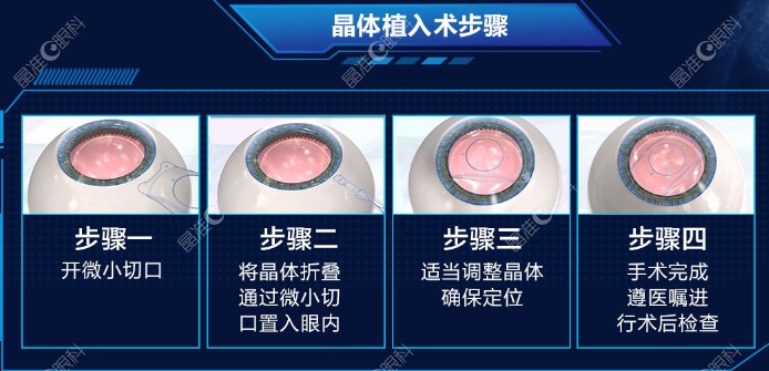 刘保松医生做近视手术怎么样