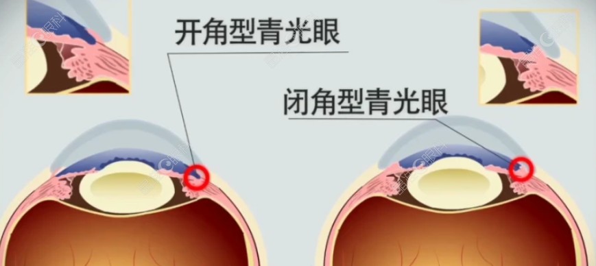 闭角型和开角型青光眼www.ji-zhun.com