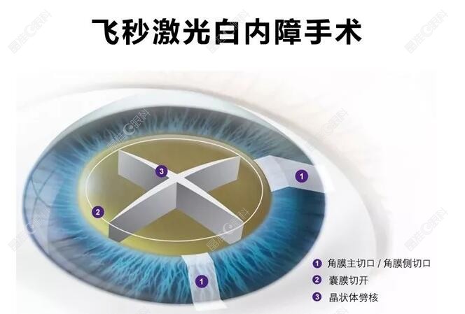 飞秒激光白内障手术价格8k+