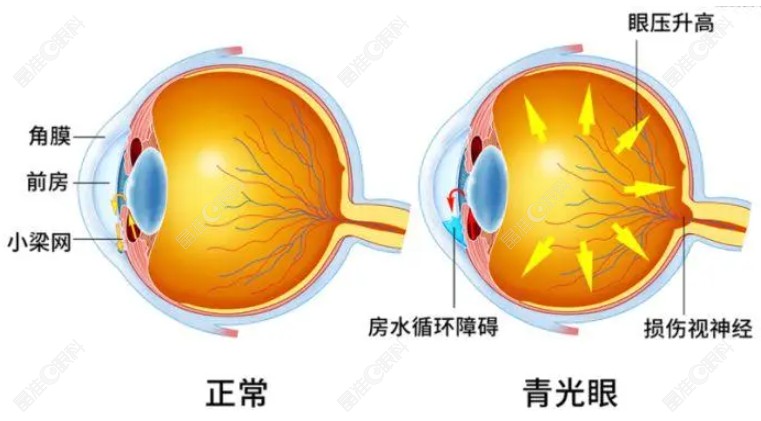 青光眼
