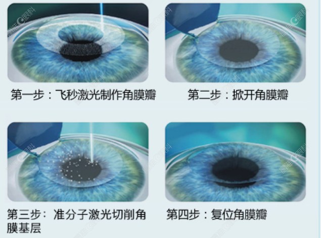 二次近视可以选择半飞秒激光手术