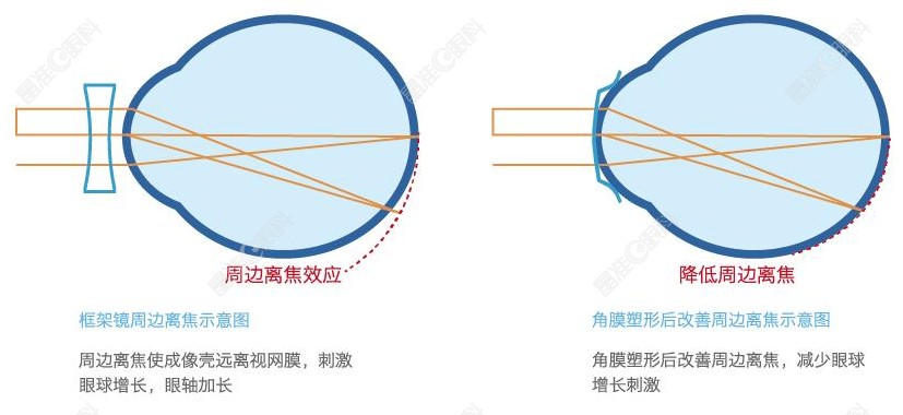 韩国露晰得的常规片OK镜怎么样