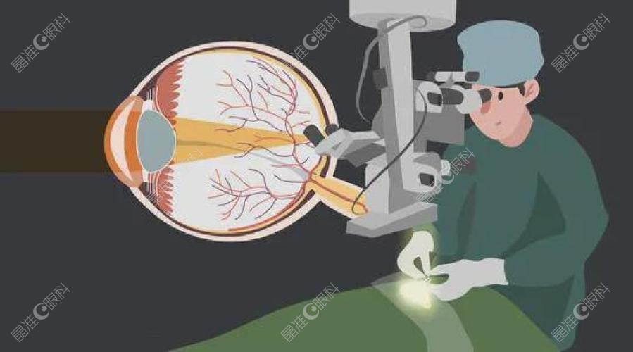 全飞秒激光手术一辈子只能做一次吗