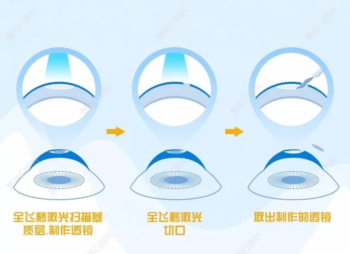 全飞秒激光近视手术过程www.ji-zhun.com