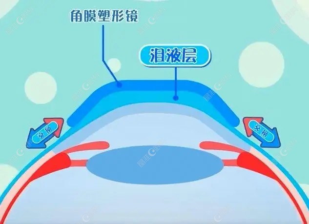 停戴角膜塑形镜多久可以恢复角膜形态？www.ji-zhun.com