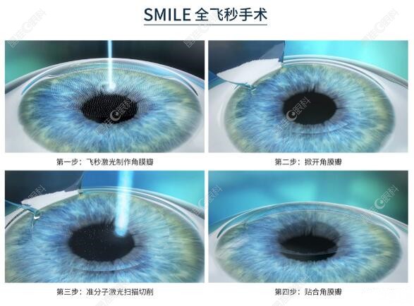 成都全飞秒激光手术哪家好?www.ji-zhun.com