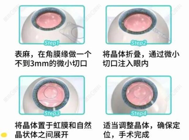 院内做晶体植入手术的矫正原理