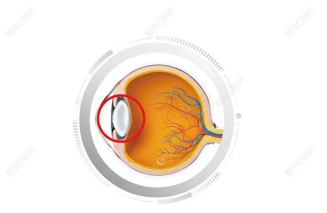 白内障的眼睛