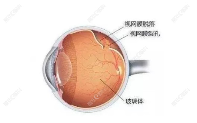 视网膜裂孔不治疗可能会发展为视网膜脱落