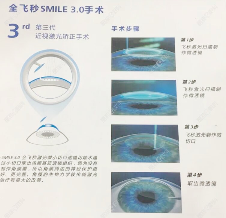 庆阳博视眼科医院做全飞秒激光手术好