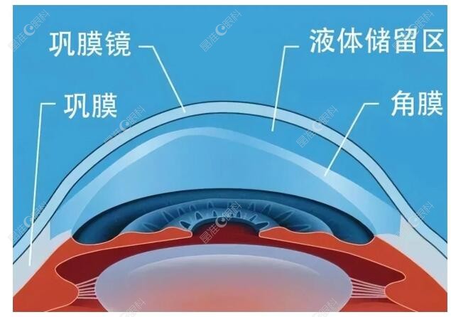 巩膜镜价格多少钱一副