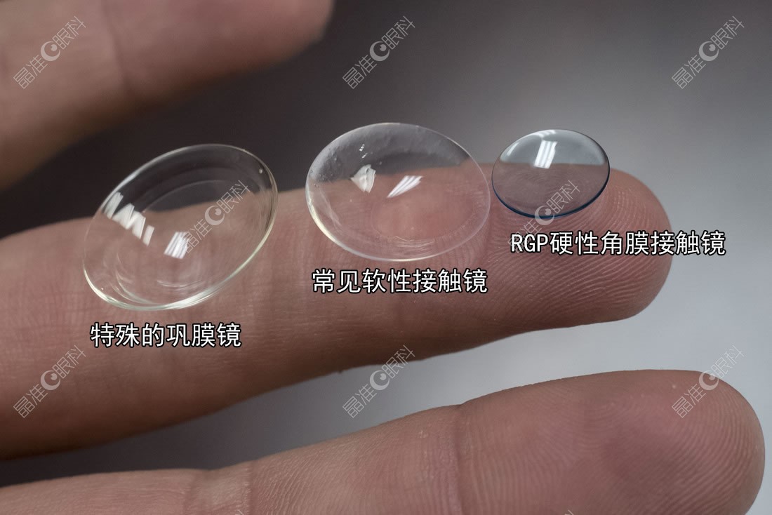 巩膜镜可以治疗干眼症