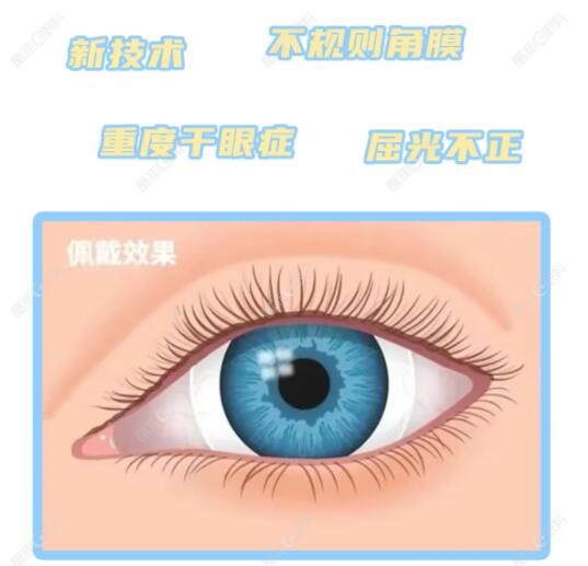 巩膜镜的作用原理