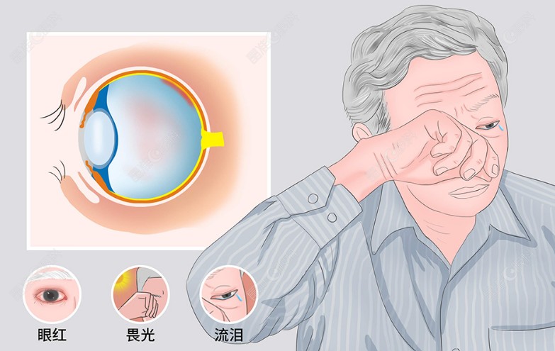 葡萄膜炎恢复后可以做近视手术吗