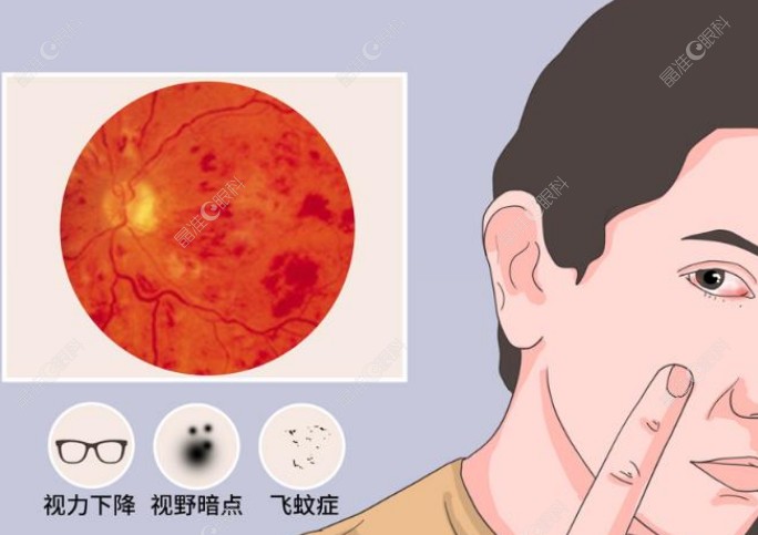 得过葡萄膜炎可以做近视手术吗