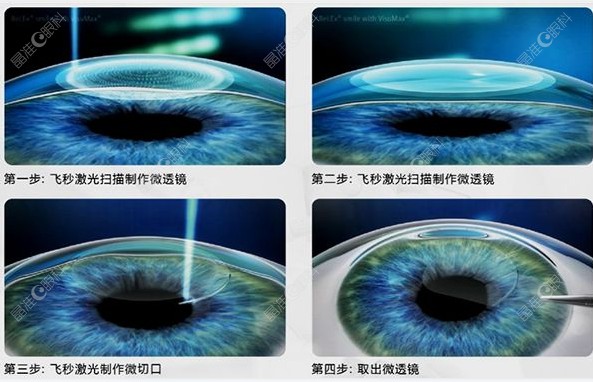 深圳全飞秒激光近视手术过程