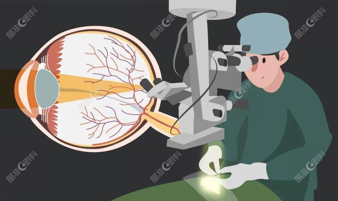 青光眼可以做激光手术的原理www.ji-zhun.com