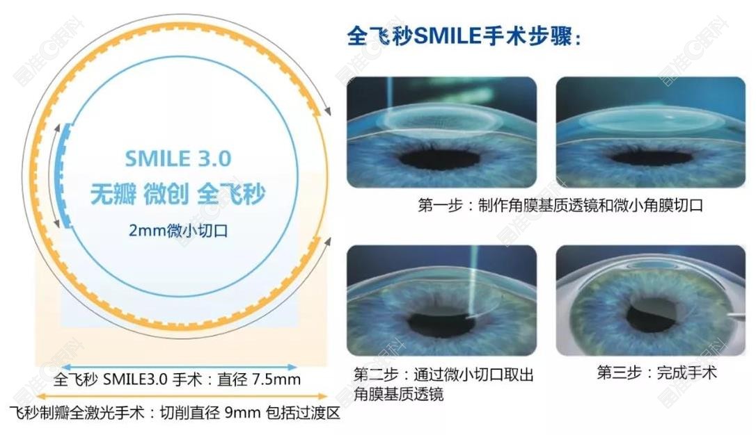 哈尔滨普瑞眼科医院全飞秒手术价格