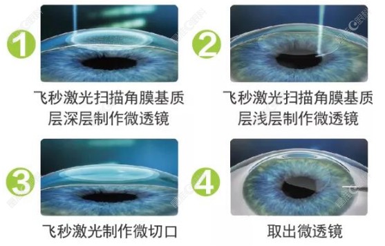 全飞秒不是把眼角膜削薄了www.ji-zhun.com