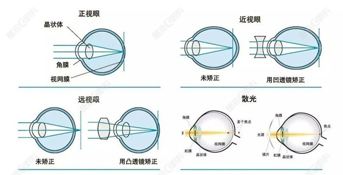 屈光不正和近视眼的区别是什么