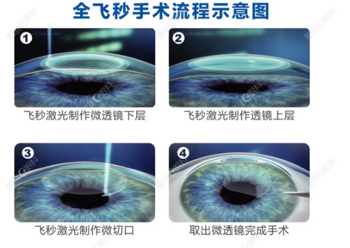 昆明眼科医院做全飞秒近视手术www.ji-zhun.com