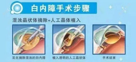 林丁医生做白内障手术过程www.ji-zhun