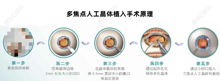 60岁以上做白内障手术更推荐采用多焦点晶体