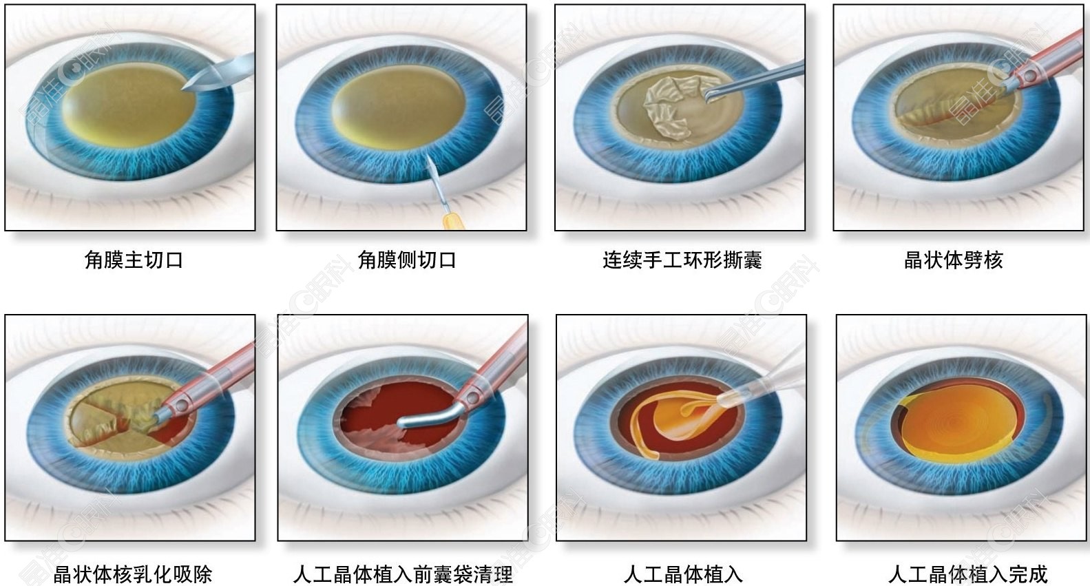 edof人工晶体植入手术