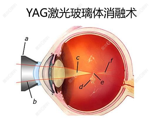 YAG激光玻璃体消融术www.ji-zhun.com