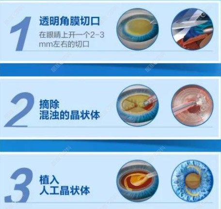 深圳白内障手术价格不同