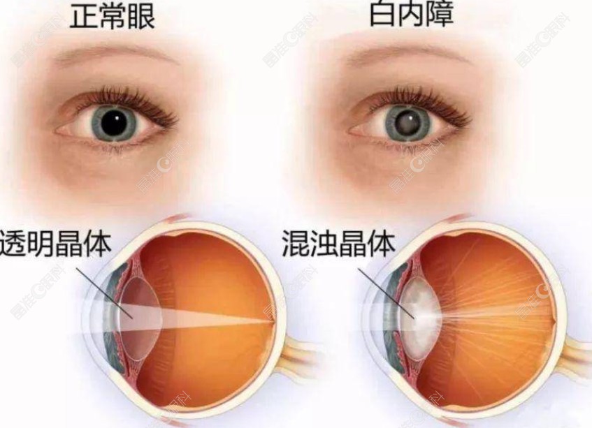 深圳白内障晶体植入要2600起