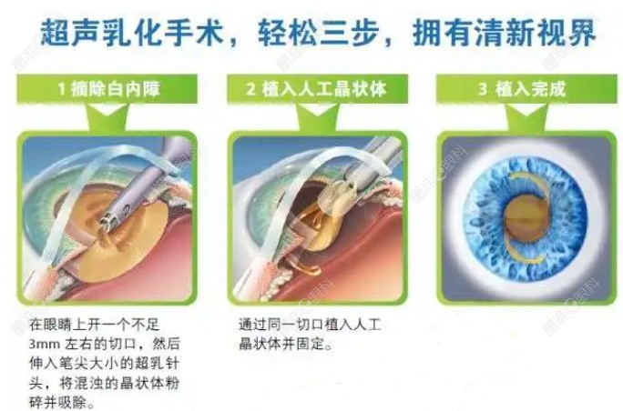 深圳白内障晶体植入手术过程