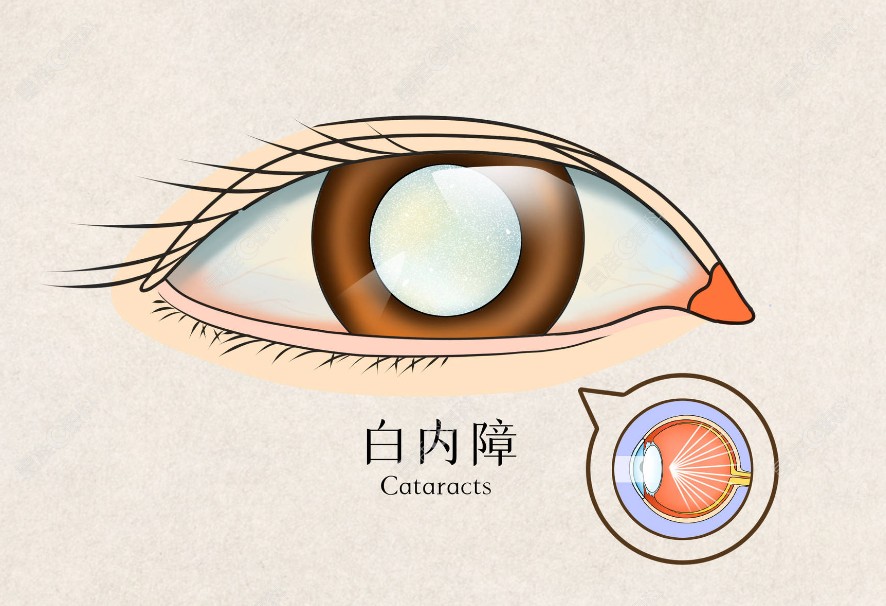 白内障