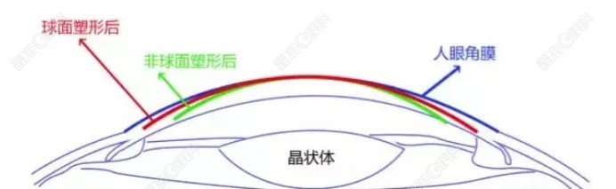普诺瞳角膜塑形镜近视控疗效好