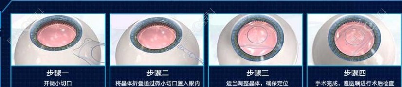 昆明普瑞眼科做晶体植入手术过程