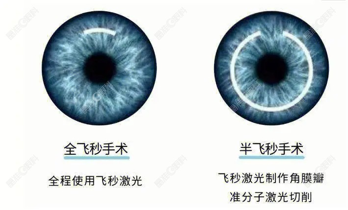 南宁麦迪格眼科做成人散光近视矫正能用全飞秒或半飞秒改善