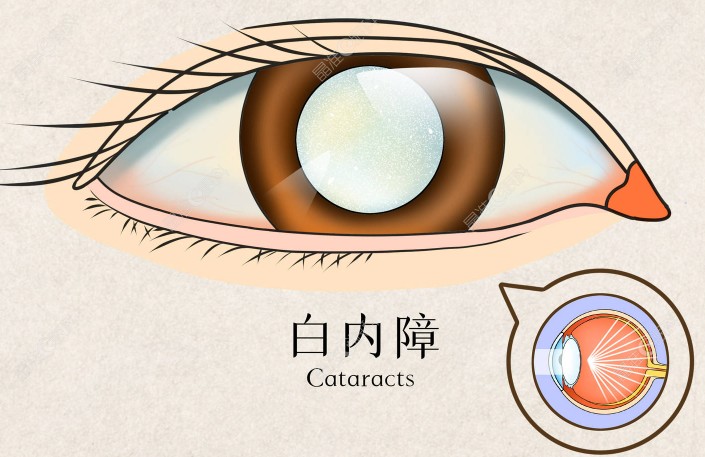 广州雷诺眼科开展白内障项目