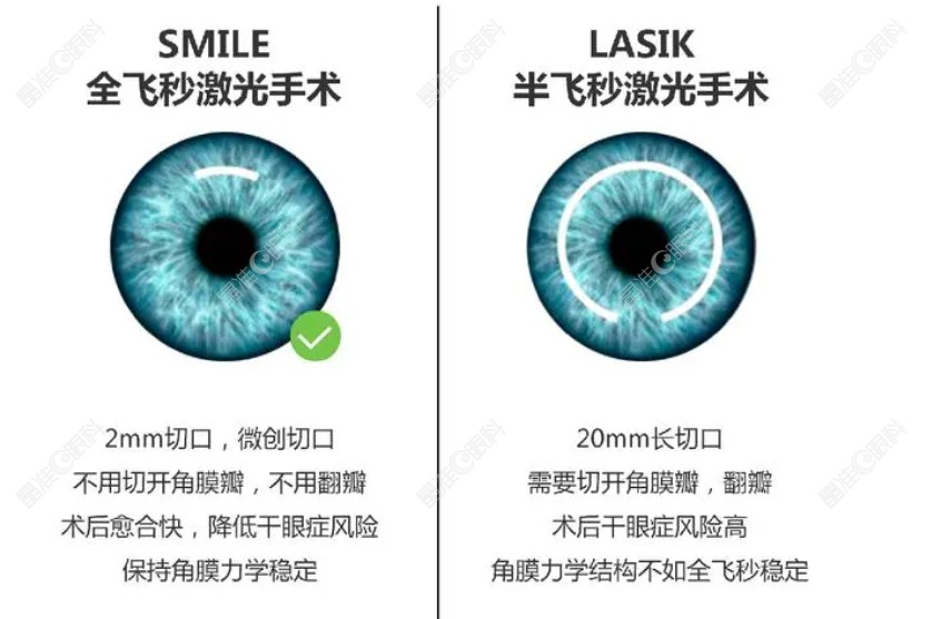 全飞秒和半飞秒近视手术区别
